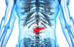 췌장암 초기증상과 좋은 음식