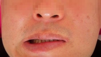 구안와사의 치료