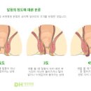 치질 초기 1기 2기 말기 이미지