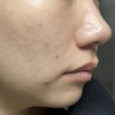 원장안 | 신논현역피부과추천 쥬베룩 스킨 효과 기계 통증 가격 원장님 친절하고 안아픈곳 솔직후기