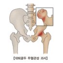 대퇴골두 무혈관성 괴사 (AVN of hip(femoral head)) 이미지