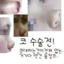 코 수술 전후 사진이에요~ 이미지