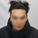 작은자의집 - 논산시 | 남자 M자 모발이식 후기 ⑤ 리터치 20모낭 후기