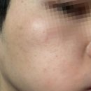 김한의원 | 강남 한의원 편평사마귀제거 기미잡티레이저 내돈내산 10일차 후기