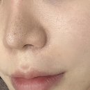 송파역피부과 미라젯 쥬베룩 스킨부스터 후기(부작용, 흉터)