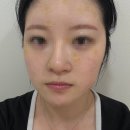야누스 | [김포 구래동 피부과]주말 진료 솔직 후기 (feat. 야누스 프로 진단부터 점+편평 사마귀 빼기 시술 과정...