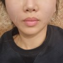 천호한의원 | 천호 안면비대칭 교정 한의원!! 얼굴 작아진 솔직후기