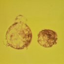 자람한방병원 | 신설 마리아 시험관 1차 과정, 김묘선 과장님 한방에 성공 ! 그러나...