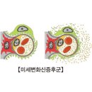 신증후군 [nephrotic syndrome] 이미지