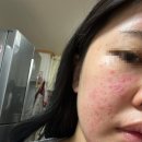 서울아산병원 외래 후기 (궤양성대장염, 생물학 제제, 궤양성대장염 완치)
