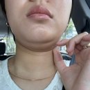 대구 온다리프팅 중구 피부과 이중턱 팔자주름 피부탄력 솔직후기