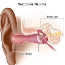 전정신경염 증상, 원인 및 치료 (귀어지럼증, 전정기관염, 어지러움 구토) 이미지