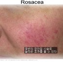 Systemic Therapy for Rosacea(피부 모세혈관 확장증) 이미지