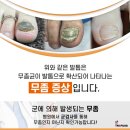 나도손톱 레푸스 개봉점 이미지