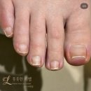 네일, 춘삼월 | 풋풋한리쌤 부산서면점 문제성발톱 내성발톱 교정 후기