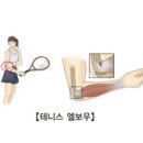 테니스엘보 (Tennis Elbow) 이미지