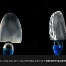 수정기공사 | [무삭제 라미네이트] 1년 사용 후기｜변색·착색치아 내돈내산 리뷰 (투디치과)