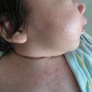 상구슈퍼 | [ 육아일기 ] 1개월 아기(D+37~43일) | 태열과 변비, 그리고 수면교육