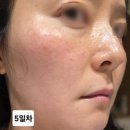 루비마로 | 대구 피부과 기미 박멸 프로젝트 루비레이저 2회 내돈내산 후기
