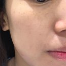 그란피코 | 수원 망포역 피부과 피코하이 레이저 기미주근깨 색소치료 후기