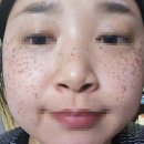 세안의원 | [내돈내산 시술후기]압구정 루나의원 루비레이저 후기- 1110방(통증,1일~2주 후기)