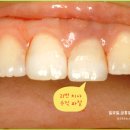 이튼튼치과의원 | 🦷 “앞니에 피가 나고 아파요… 8년이 지나도 튼튼한 임플란트 치료 후기 (신촌치과)”