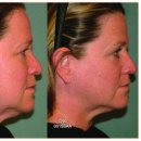 유앤아이의원 구로점 | 구로디지털단지 울쎄라, 정말 그만한 가치가 있을까?