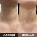 동안의원 | [강남 동안시술] 리오셀의원 목주름필러 후기