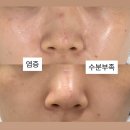 홈케어생명약국 | [구로피부관리 여드름흉터전문] 하이필스킨 구로본점 부스터테라피 후기