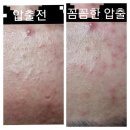 쁘리띠테라피 | 청라 피부관리 쁘리띠테라피를 추천합니다