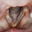 서교연세약국 | 성대 폴립(혹) 제거 수술 상세후기_연세하루이비인후과(국소마취, KTP 레이저 수술, 당일 퇴원)