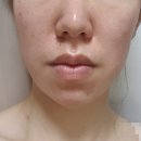 아델라에스테틱 | 인천 송도 아델라에스테틱 페이스 약초필링 받았어요. 일주일 변화 솔직후기