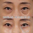하안검수술, 눈밑주름과 처짐을 한번에 해결하는 중년눈성형|강남치유성형외과