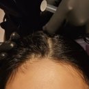 분당-6 | 정자역탈모병원 분당 여성 탈모 관리 '잔디주사' HS 6-10회차 최종 후기