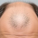 대한과학 | 3. 안드로겐성 탈모의 원인과 진행 과정에 대한 과학적 설명