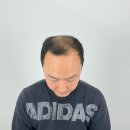 실제 삭발두피문신 후기[ft. 그레이시티 청라점 인천두피문신 제임스]