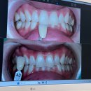 벨치과의원 | 신사역 레브치과 치아미백 내돈내산 후기 ( 이시림, 잇몸 부작용 후기 )