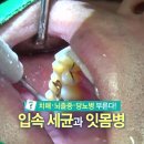 치매·뇌졸중·당뇨병 부른다! 입속 세균과 잇몸병 이미지