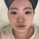 메종드엠의원 | [미용]온다리프팅/강남피부과/강남클리닉/논현리프팅/내돈내산;메종드엠의원 40KJ 리프팅