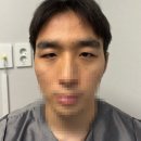 (주)탑스코 | 남자눈성형 안검하수 졸린눈 비절개눈매교정 후기 전후사진