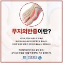 엄지발가락에서 나타나는 김포무지외반증 치료는? 이미지