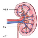 사구체 신염 원인 증상 치료 이미지