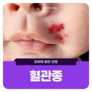 엠허브미의원 | 대전혈관종 피부에 갑자기 생긴 붉은 반점