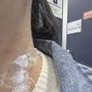 새론한방병원 | [새론 한방 병원] 논현동 쥐젖 제거 후기