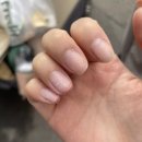히포닉네일