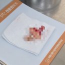 연제구-144 | 사랑니 발치 후기 : 사랑니랑 구강악안면외과