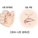 레쉬-니한 증후군(Lesch-Nyhan syndrome) 유전질환이란? 이미지