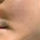 초이몽 | 용산피부관리[초이몽에스테틱] 맥슈어 Macsure, 남자여드름흉터치료 후기