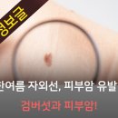 [건강정보 정보]여름철 자외선 피부암 유발 한다 검버섯과 피부암 이미지