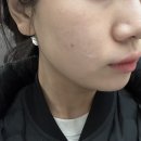 제이스타성형외과의원 | "제이앤성형외과" 강남역성형외과_쿼트로레이저_내돈내산 후기 (솔직 경험담)